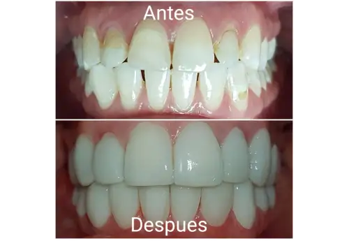 Diseño de sonrisa en cerámica