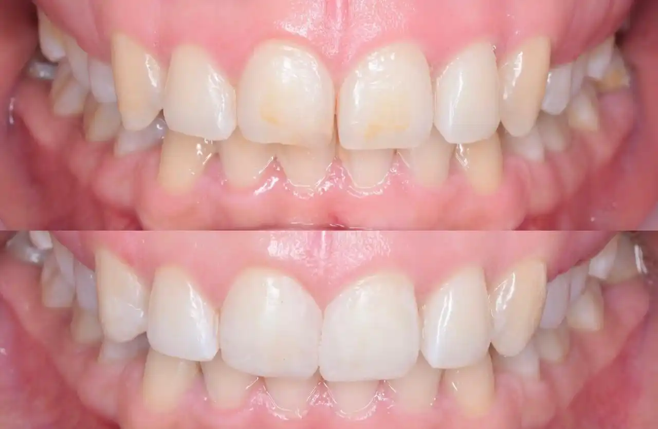Blancamiento dental
