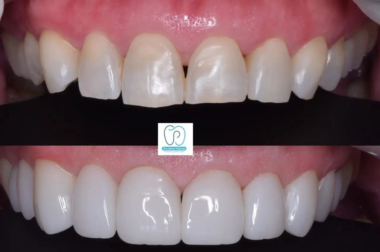 diseño de sonrisa en porcelana